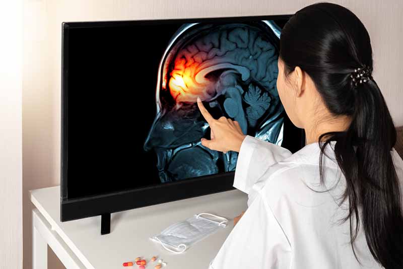 Maximize Your Compensation with the Help of a Traumatic Brain Injury Glendale Lawyer doctor looking at brain MRI result